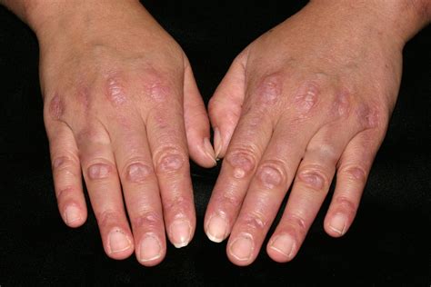What Causes Eczema On Knuckles